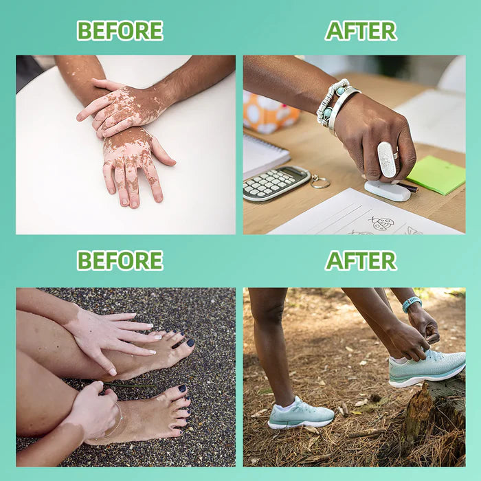 KTS 311nm UVB light therapy treatment for psoriasis vitiligo