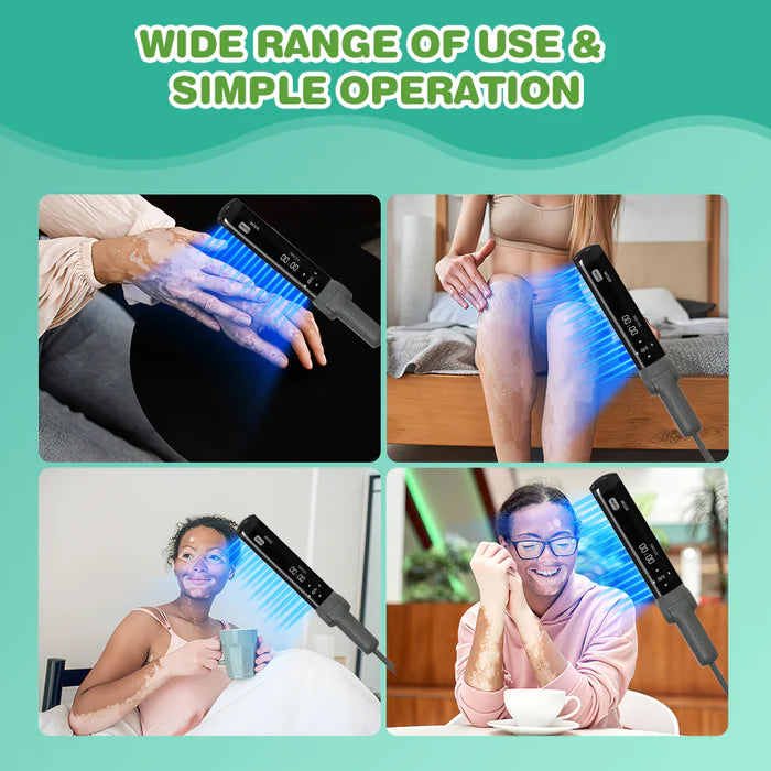 KTS 311nm UVB light therapy treatment for psoriasis vitiligo