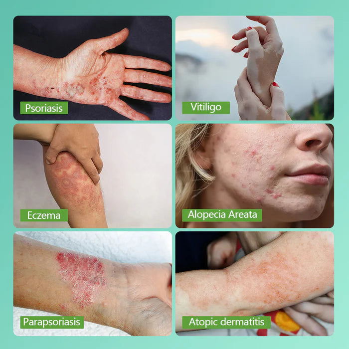 KTS 311nm UVB light therapy treatment for psoriasis vitiligo