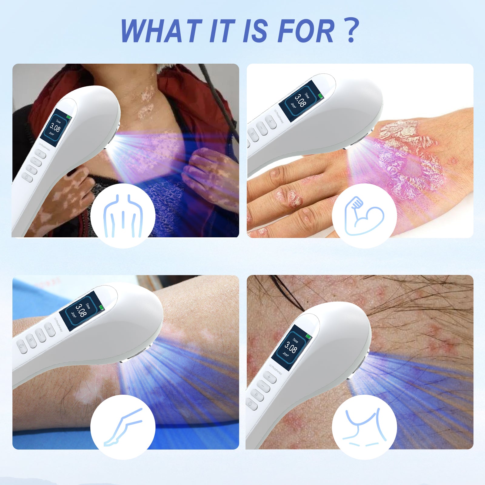 Appareil de luminothérapie portatif UVB pour vitiligo/psoriasis KTS