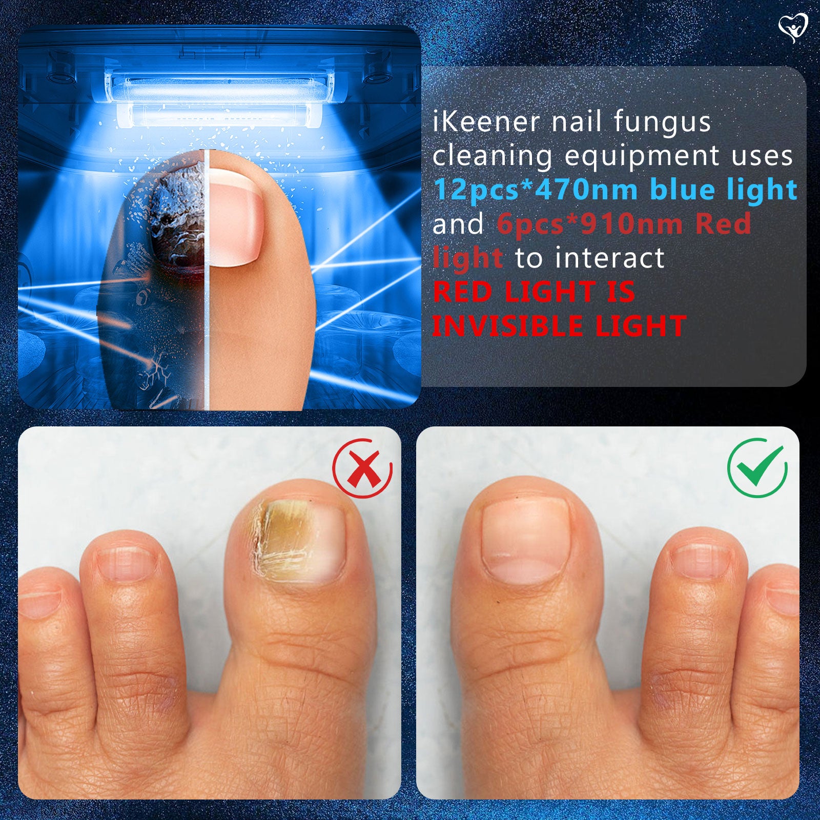 Lumière pour champignons d'ongles pour ongles d'orteils multiples