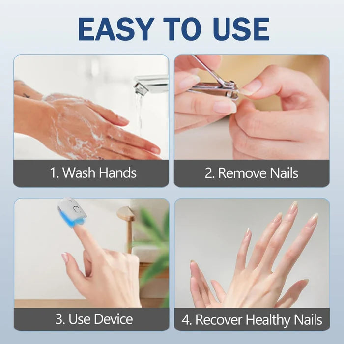 Appareil de traitement fongique des ongles KTS