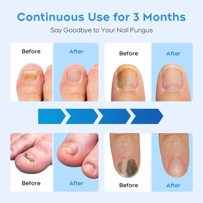 Lampe anti-champignons pour ongles multiples