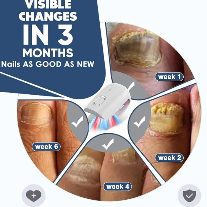Appareil de traitement fongique des ongles KTS