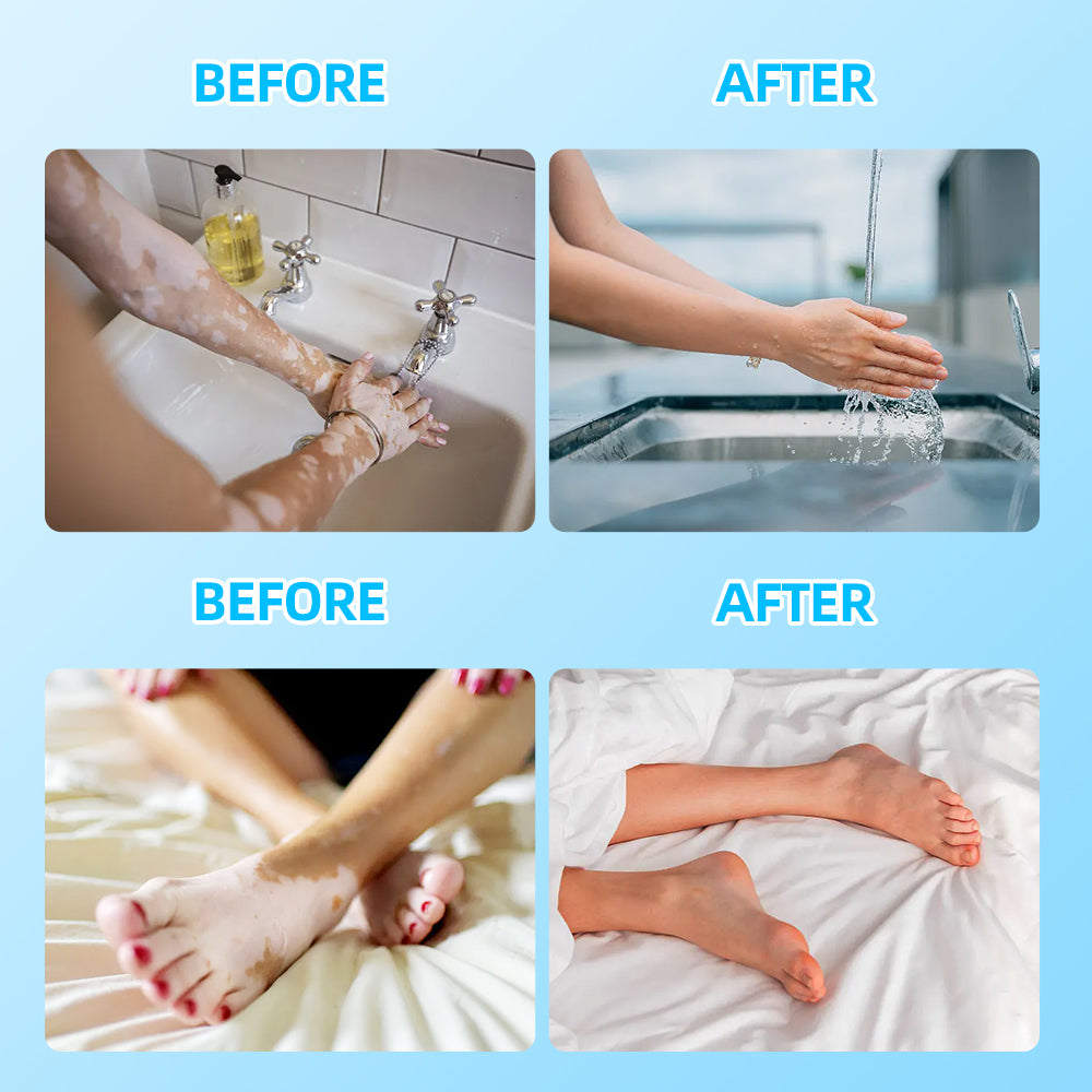 Appareil de thérapie par lumière excimère UVB 308nm KTS