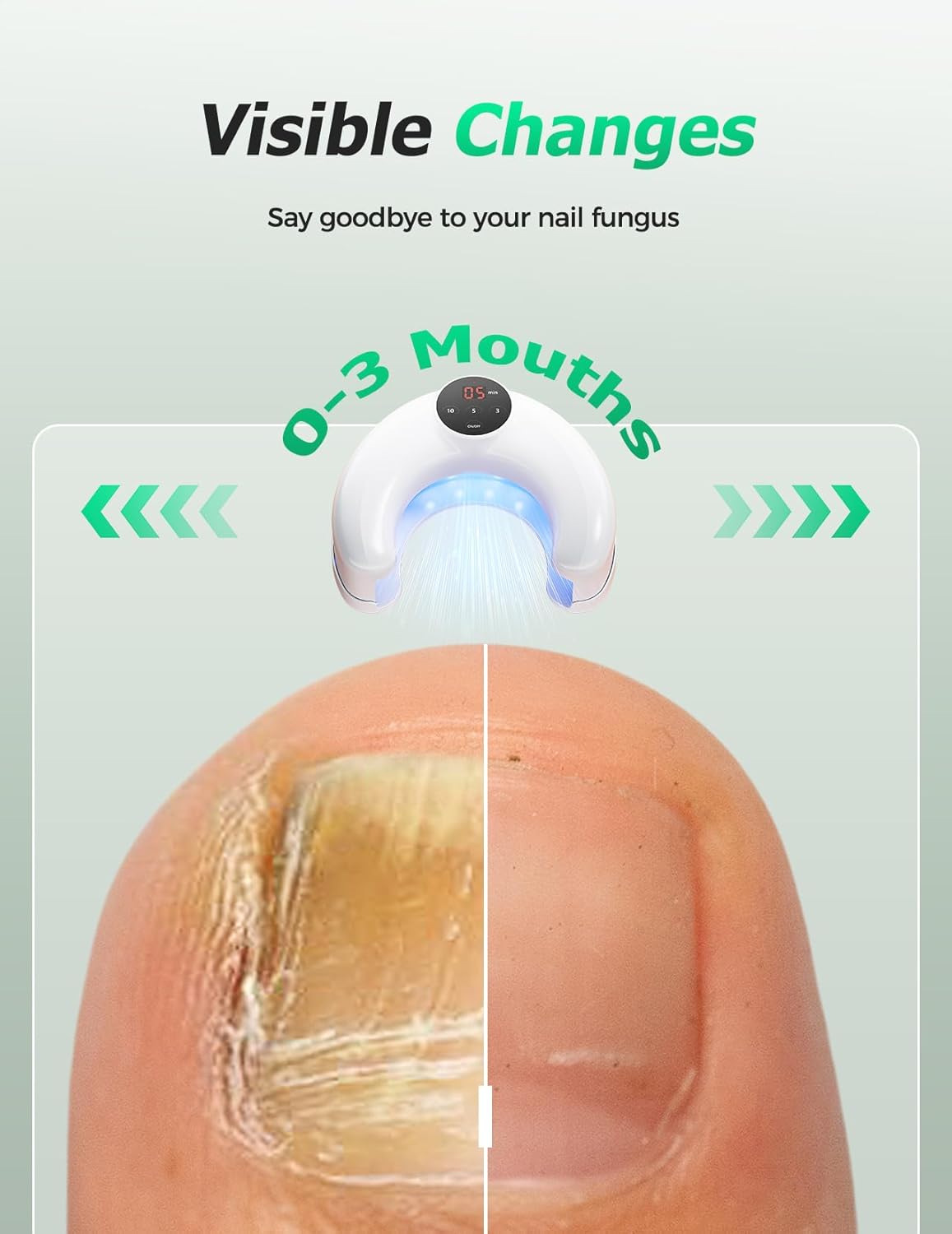 Appareils sans fil de traitement au laser de la mycose de l'ongle pour les ongles multiples