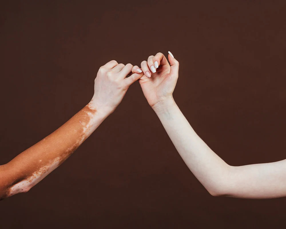 Le vitiligo est-il contagieux ?